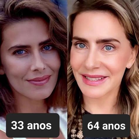 Botox Antes E Depois Em 20 Fotos
