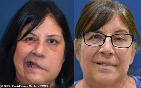 Stroke Victim 56 Who Looked Like A Monster Smiles For The First