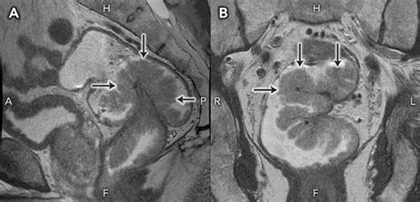 Giant Villous Adenoma Presenting As Mckittrickwheelock Syndrome And