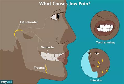 Myofascial Pain Management Tmj Pain Jaw Pain In Dubai