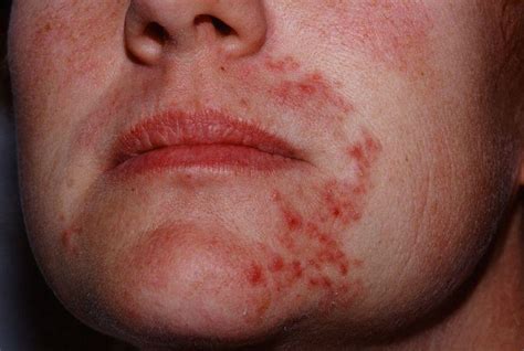 Type Of Skin Diseases Why Dry Skin Rash On Legs Nose Genitals Or