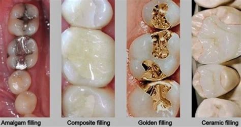 Which Filling Is Best For Teeth Favourite Dentistry