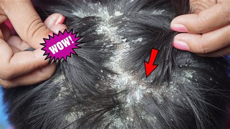 Dandruff Removal Itchy Dry Scalp Huge Flakes Psoriasis Treatment And