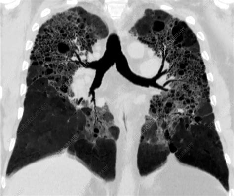 Lungs In Hypersensitivity Pneumonitis Ct Scan Stock Image C034
