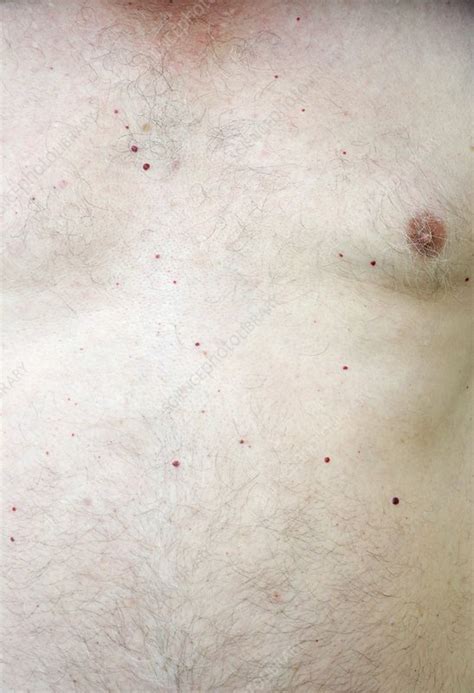 A cherry hemangioma, aka campbell de morgan spot, is a common red spot on the skin, usually small. Campbell de Morgan spots - Stock Image - C018/3552 ...