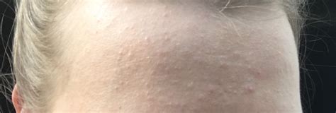 Bumps On Forehead General Acne Discussion