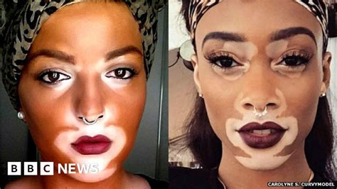 The Model Who S Bringing A Rare Skin Condition Into The Open Bbc News