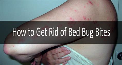 Bed Bug Bites Definite Symptoms Signs Treatment Strategy