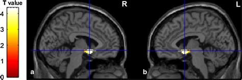 T1 Weighted Brain Mri Sequences Superimposition Showing The Significant