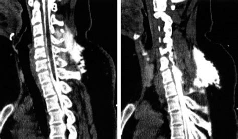 Contrast Enhanced Ct Of Cervical Spine There Is Fluid Collection In