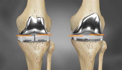 3d Printed Knee Replacement