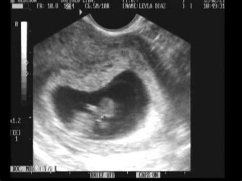 Vídeos de la semana 9 de embarazo. Ecografía 9 semanas de gestación gpardox - YouTube