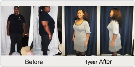 Sleeve Gastrectomy Gastric Sleeve Before And After Skin Celebrities