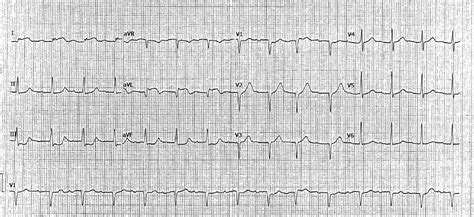 Dr Smiths Ecg Blog What Is The Culprit Vessel