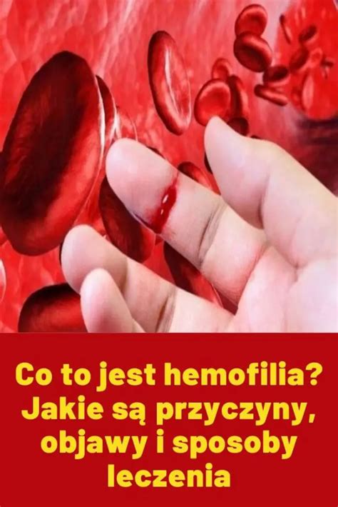 Hemofilia Rodzaje Objawy I Przyczyny Jak Leczy Si Hemofili The Best Porn Website