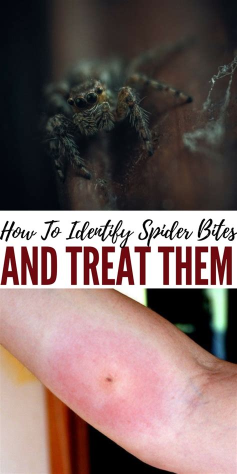 How To Identify Spider Bites And Treat Them