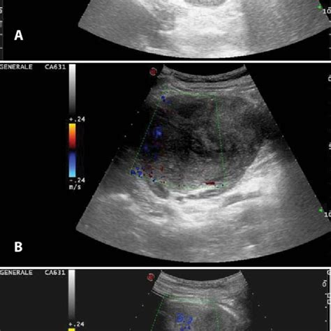 Wilms Tumor In A 5 Year Old Baby Girl Ultrasound Images Of Right