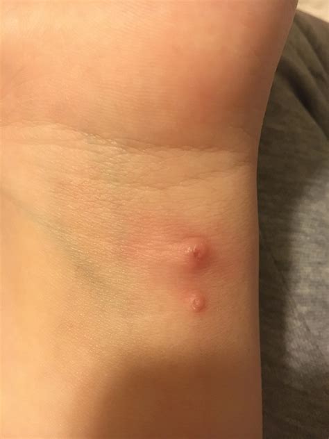 Weird Bumps On Arm That Are Hard And Have A Bit Of Pus Within Them