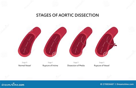 Blood Vessel Anatomy Disease Infographic Chart Vector Color Flat