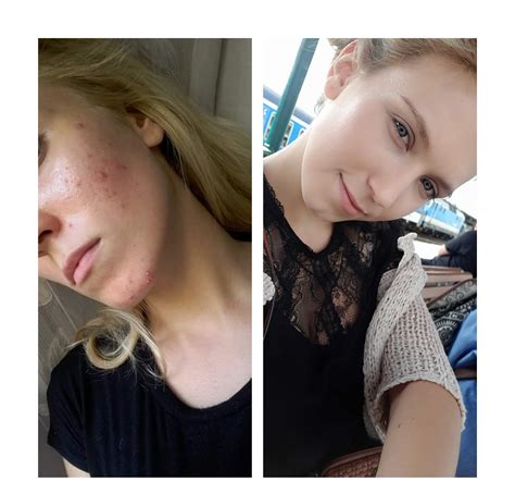 Acne My Skin Before And My Skin A Year After Accutane R
