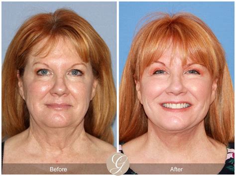 Facelift Fifties Before And After Photos Patient 45 Dr Kevin Sadati