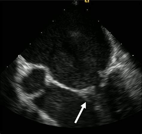 Cureus Native Mitral Valve Infective Endocarditis From Flossing A Case Report And Emergency