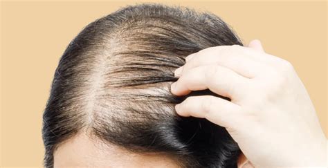 Discover 74 Hair Loss And Thinning Vova Edu Vn