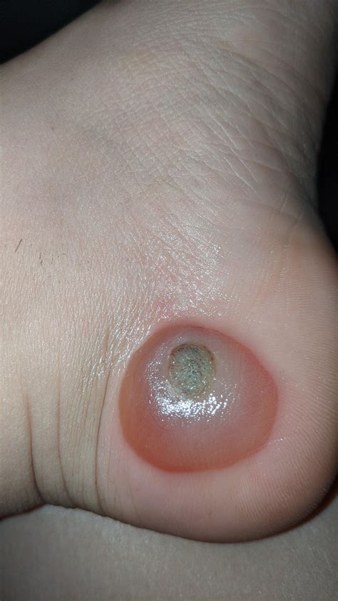 Can I Pop A Cryotherapy Blister Thats Causing Pain Raskdoctorsmeeee