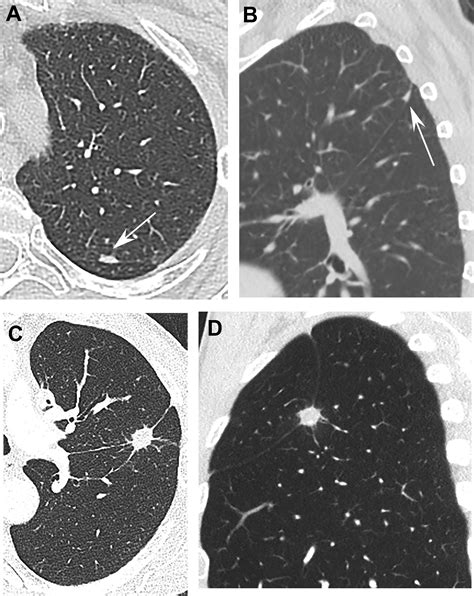 Incidental Lung Nodules On Cross Sectional Imaging Radiologic Clinics