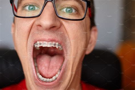 Curved Teeth Of Guy With Braces In G Featuring Braces Tooth And