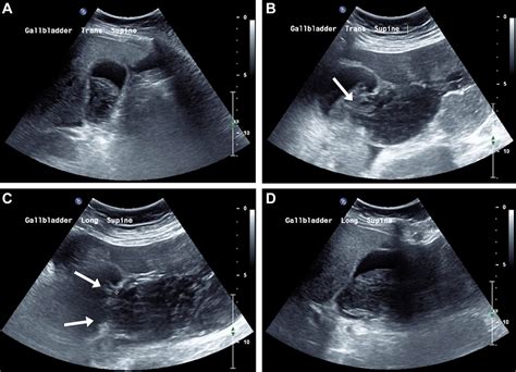 Perforated Gallbladder Ultrasound
