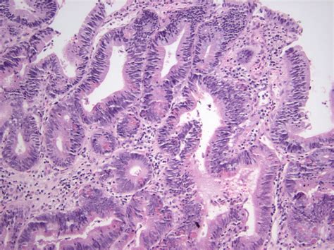 Pathology Outlines Intra Ampullary Papillary Tubular Neoplasm IAPN