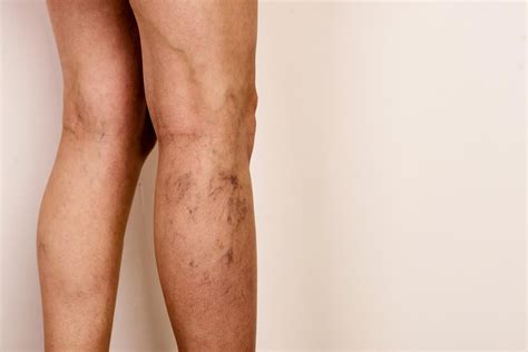 What Causes Varicose Veins Varicosities In The Legs