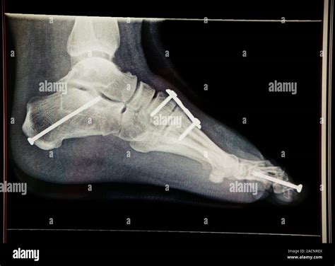Pinned Foot Bones After Surgery Lateral Side View X Ray Showing Pins