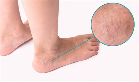 Varicose Veins In The Feet What Is The Cause Pedes Orange County