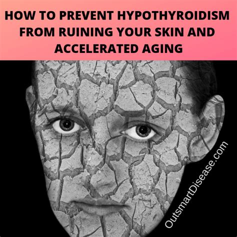 Hypothyroidism Dry Skin Treatment