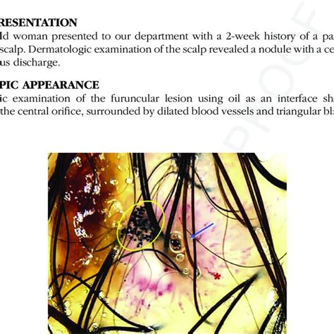 Furuncular Myiasis Dermoscopy Revealed Bubbles Arising From The Download Scientific Diagram