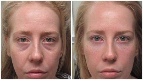 Incredible Tear Troughunder Eye Filler Results Under Eye Fillers