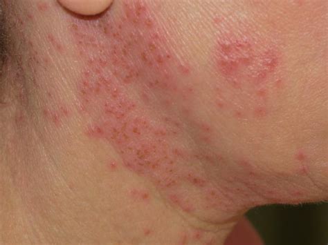 Eczema Herpeticum Sintomas Diagnóstico E Tratamento Respostas