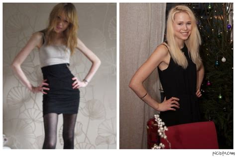 A Life Without Anorexia Im Wieght Restored What Happens Now