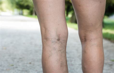 Varicose Veins What Are They And How To Treat Them Northants Life