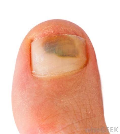 Bruised Toenail From Hiking Treatment Quotes Update
