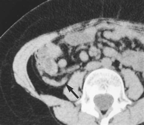 Unenhanced Limited Ct Of The Abdomen In The Diagnosis Of Appendicitis
