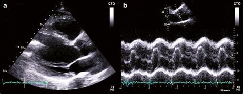 Parasternal Long Axis And Aortic Valve M Mode Of A 63 Year Old Male