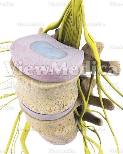 Viewmedica Stock Art Lumbar Disc Degeneration Detail With Nerves