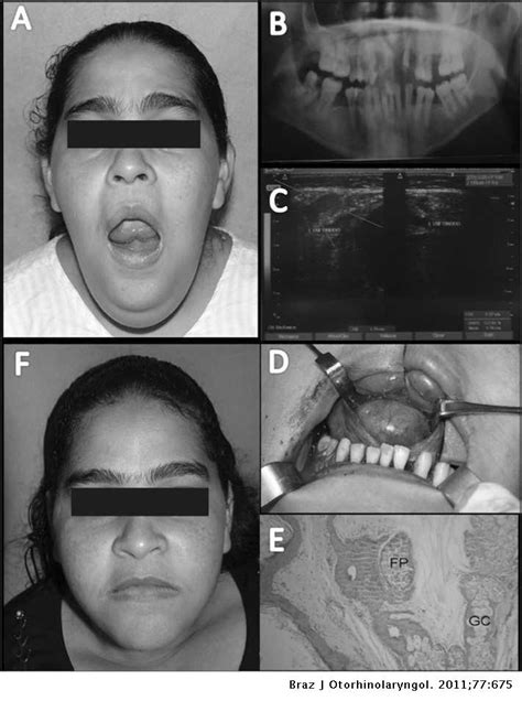Iatrogenic Infection In Dermoid Cysts Of The Floor Of The Mouth