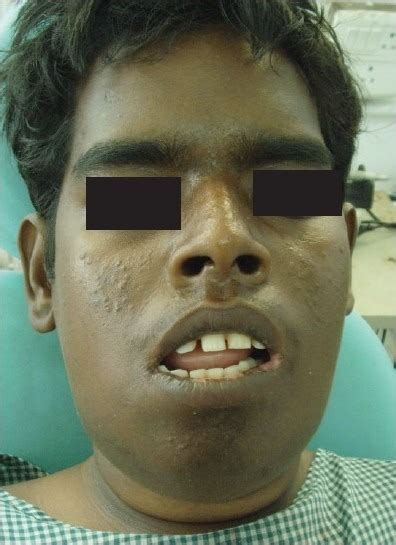 Preoperative Appearance With Bilateral Involvement Of The Download