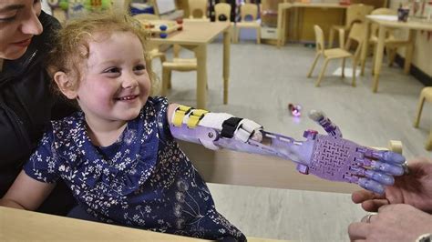 girl born without forearm gets frozen themed prosthetic girl prosthetics old girl