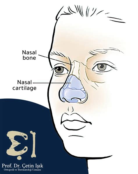 Nose Fracture Treatment Manual And Surgical Response Prof Dr Çetin