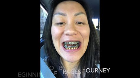 Double Jaw Surgery For Underbite Before And After Post Op 3 Weeks